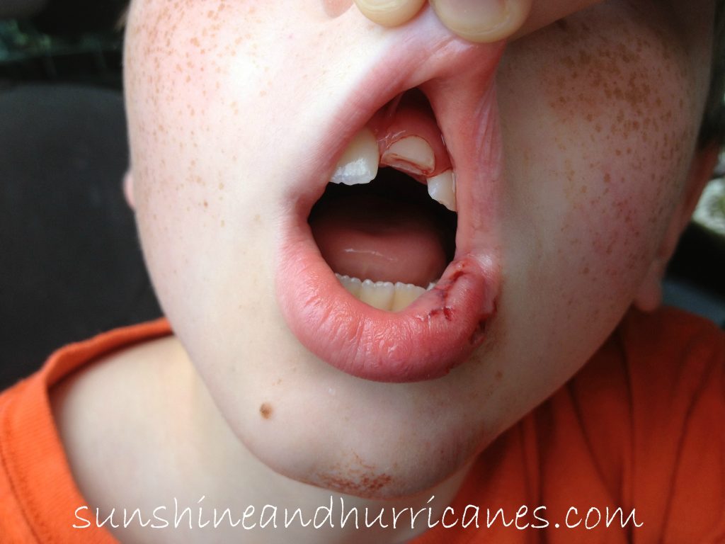 Handling Kid's Dental Injuries