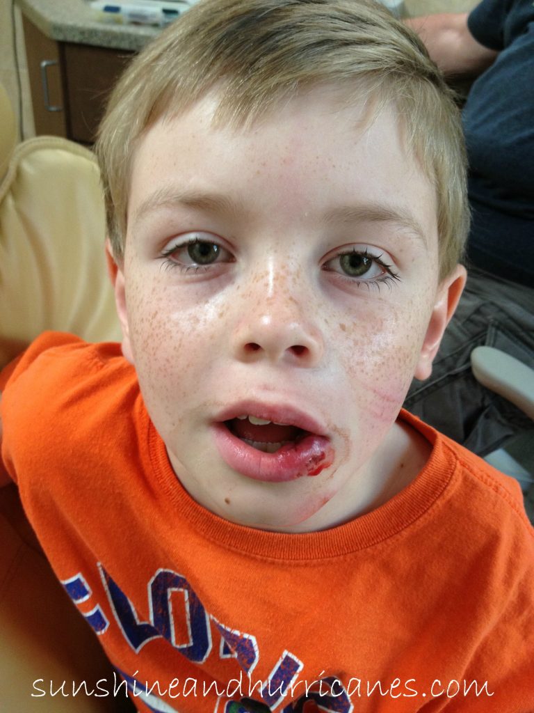 Kid's Dental Injuries